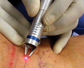 Kako se izvaja lasersko zdravljenje varikoznih žil