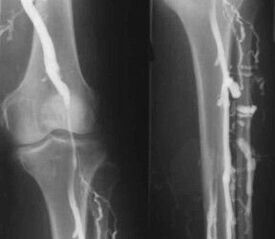 Možnosti diagnoze krčnih žil na okončinah