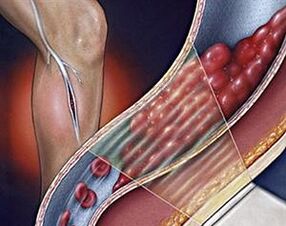krčne žile globokih ven spodnjih okončin